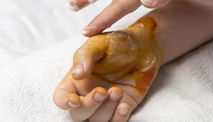 tips to get relief if you are burnt,healthy living,Health tips