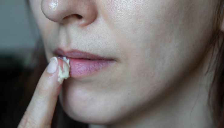 dry lips remedies,natural lip care,how to treat chapped lips,home remedies for cracked lips,causes of dry lips,soft lips tips,lip care without chemicals,best treatment for dry lips,natural cure for chapped lips,dry lip solutions