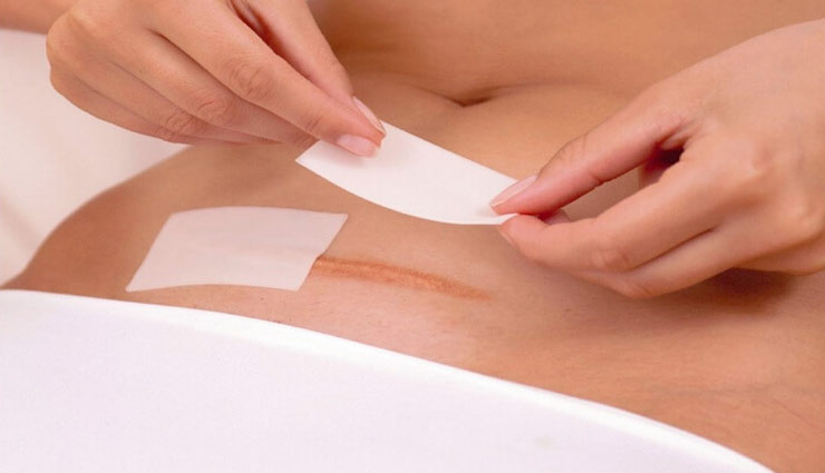 caesarean delivery,caesarean delivery caution,Health tips