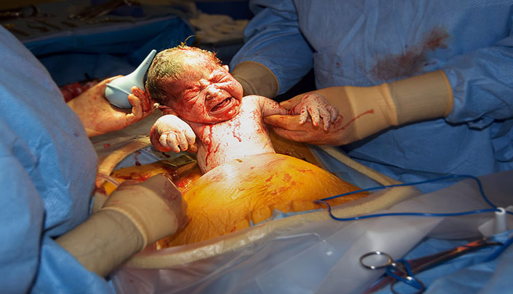 सिजेरियन डिलीवरी के बाद बरते सावधानी, बचे इन 5 कामों को करने से 