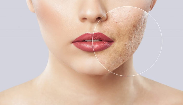 4 DIY Ways To Use Camphor for Acne Treatment