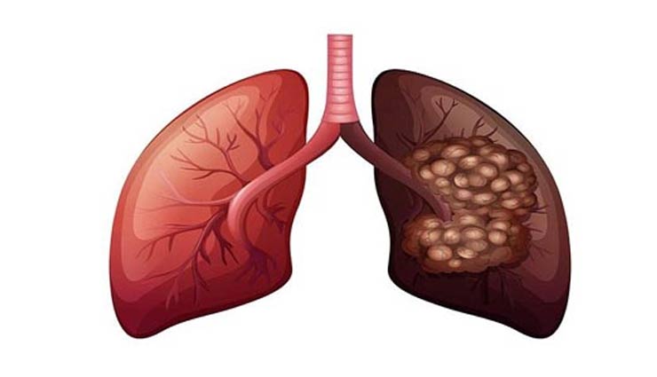 lung cancer,symptoms,lung cancer causes,lung cancer treatment,Health tips,healthy living