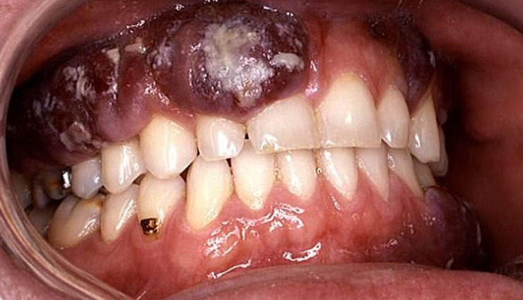 Health tips,chewing betel,side effect of betel,problem by betel