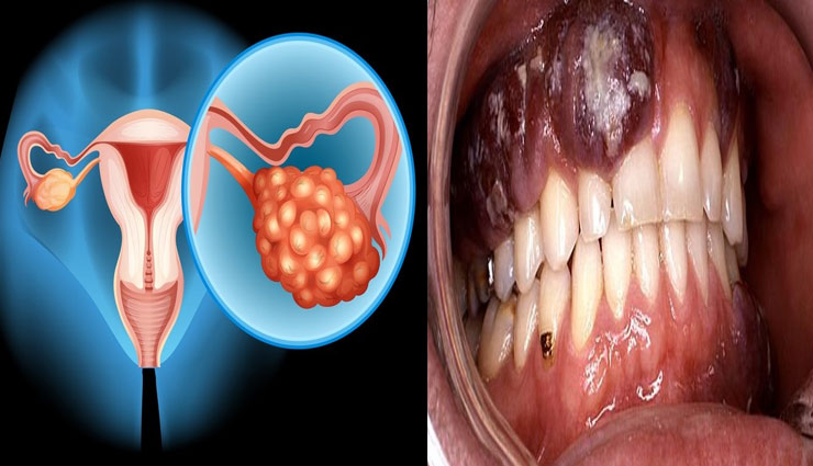 महिलाओं पर बना रहता है इन 5 तरह के कैंसर का खतरा, जानें लक्षण और बरते सावधानी Health tips,women,women at risk these cancers,5 types of cancers,cancer sympotoms