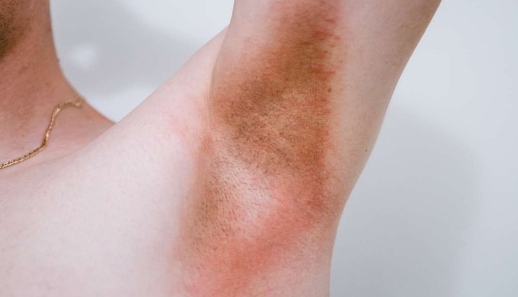 Easy Home Remedies To Treat Candida