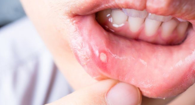 canker sores,home remedies,Health tips,healthy living,simple health tips