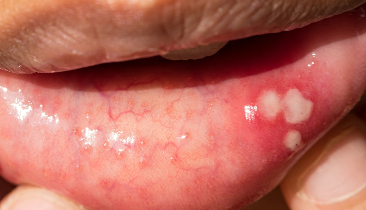 common mouth problems,tongue issues,dental hygiene,oral health concerns,mouth and tongue conditions,dental caries prevention,periodontal disease prevention,amalgam tattoo,halitosis treatment,black hairy tongue causes,canker sore remedies,tooth decay prevention,tooth abscess treatment,cold sore management,chipped tooth repair,leukoplakia diagnosis,lichen planus symptoms,thrush treatment,oral cancer detection,dry mouth remedies