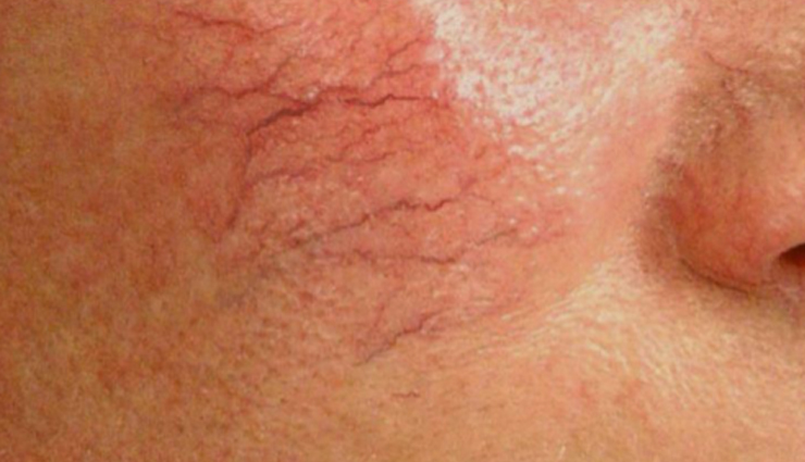 ice cubes on face disadvantages,rubbing ice cubes on face drawbacks,negative effects of using ice cubes on face,disadvantages of applying ice cubes on face,ice cube facial risks and drawbacks,problems with rubbing ice cubes on face,ice cube skincare disadvantages,potential drawbacks of using ice cubes on face,side effects of rubbing ice cubes on face,cons of applying ice cubes on face