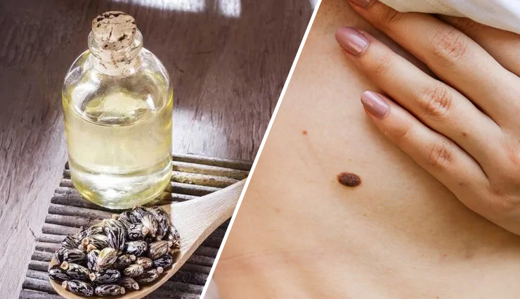 castor oil mole removal,natural mole removal with castor oil,using castor oil for mole removal,castor oil for removing moles,gentle mole removal with castor oil,effective ways to remove moles with castor oil,castor oil remedies for moles,how to naturally remove moles using castor oil,safe mole removal with castor oil,benefits of using castor oil to remove moles