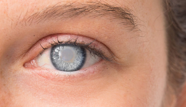 eye problems,eyes care,eye problem,blurred vision,lazy eye,diabetic retinopathy,cataract,glaucoma,blepharitis,crossed eyes,Health