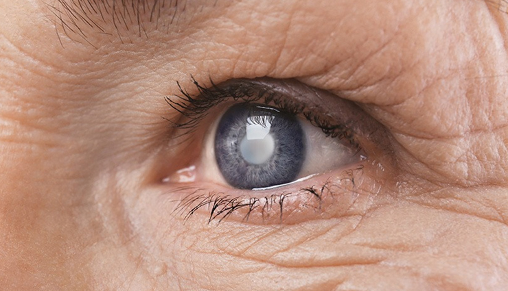 बढती उम्र में दृष्टि हानि का सामान्य कारण है मोतियाबिंद, इन घरेलू नुस्खों से मिलेगी मदद 