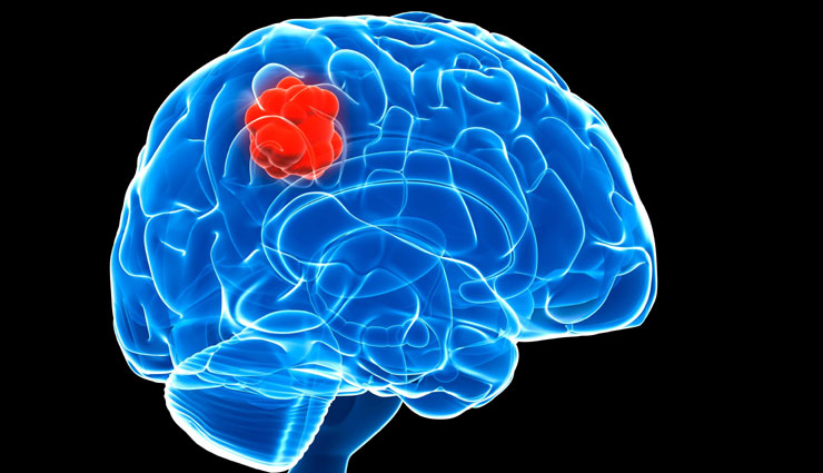 brain tumor,major causes of brain tumor,symptoms of brain tumor,Health tips,fitness tips