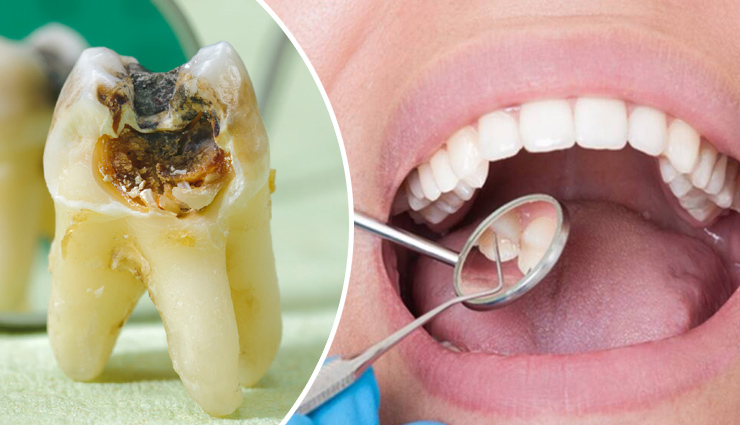 दांतों में बैक्टीरिया बनता हैं कैविटी का कारण, इन घरेलू नुस्खों से दूर करें यह समस्या 