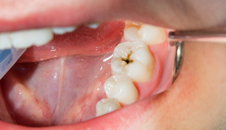 10 Home Remedies and Preventative Measures for Cavities