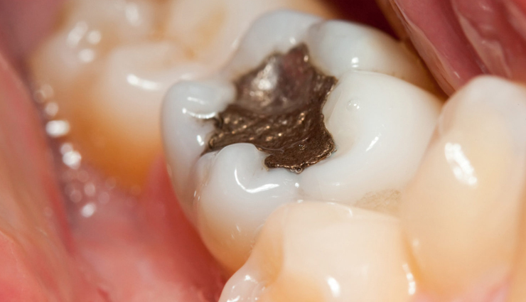 7 Effective Remedies To Treat Cavities