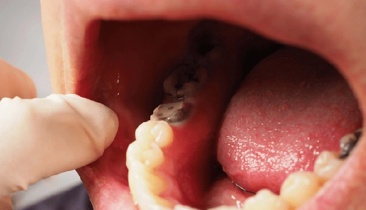 4 Ways to Help You Prevent Cavities