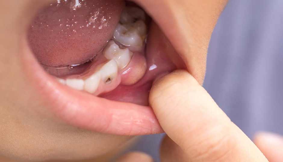 9 Home Remedies and Care for Cavities in Kids