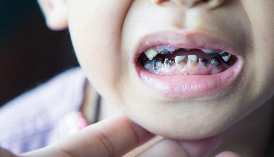 10 Home Remedies to Treat Cavity in Kids