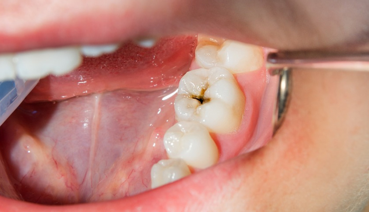 common mouth problems,tongue issues,dental hygiene,oral health concerns,mouth and tongue conditions,dental caries prevention,periodontal disease prevention,amalgam tattoo,halitosis treatment,black hairy tongue causes,canker sore remedies,tooth decay prevention,tooth abscess treatment,cold sore management,chipped tooth repair,leukoplakia diagnosis,lichen planus symptoms,thrush treatment,oral cancer detection,dry mouth remedies