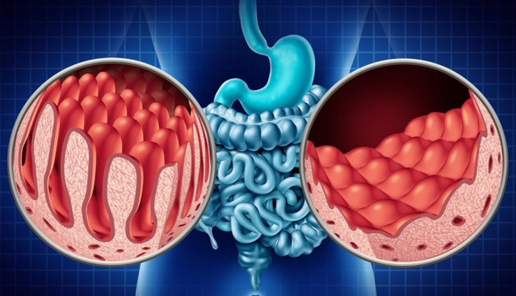 gluten-free diet benefits,health advantages of gluten-free eating,gluten-free lifestyle benefits,benefits of adopting a gluten-free diet,gluten-free diet and wellness,gluten-free living advantages,gluten-free diet impact on health,improving health with gluten-free eating,gluten-free diet benefits for body,gluten-free diet advantages for health