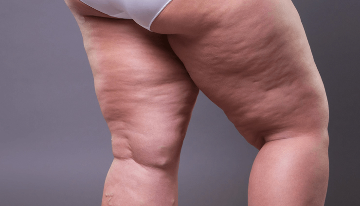 5 Natural Ways To Get Rid of Cellulite