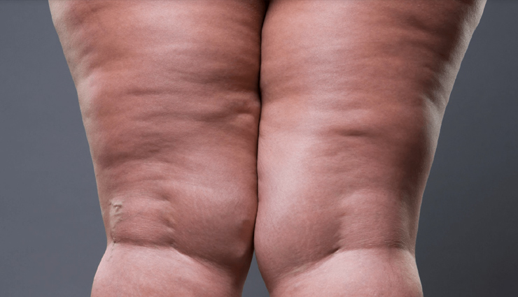 6 Home Remedies For Cellulite in Thighs

