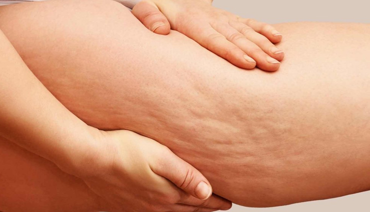 6 Foods That Can Cause Cellulite