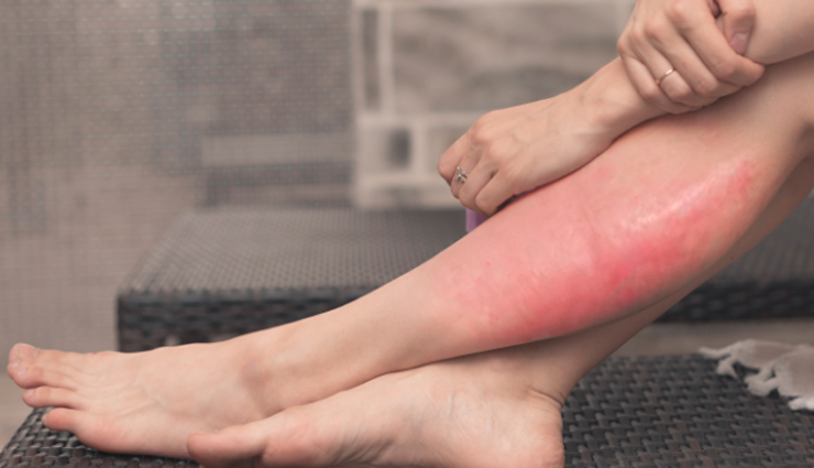 10 Home Remedies To Treat Cellulitis