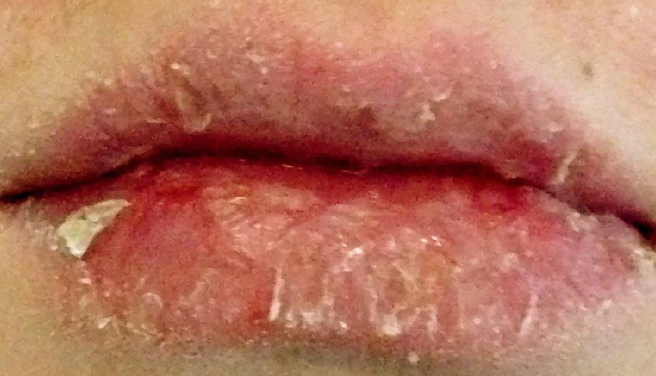 सूखे और फटे होंठों की पपड़ी से राहत चाहिए? इस होममेड लिप स्क्रब से मिलेगा तुरंत आराम, डेड स्किन होगी साफ