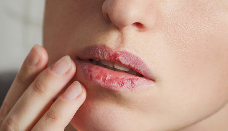 6 Effective Home Remedies To Treat Dry and Chapped Lips