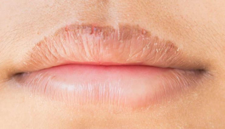 monsoon skin problems,skin issues during rainy season,common skin problems in monsoon,home remedies for monsoon skin problems,natural remedies for rainy season skin issues,getting rid of skin problems in the monsoon,monsoon skincare tips,treating skin problems during rainy season,monsoon skincare home remedies,healthy skin in the monsoon