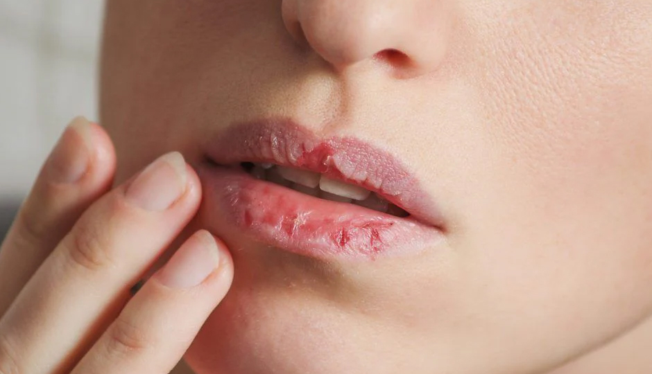 8 DIY Ways To Treat Chapped Lips