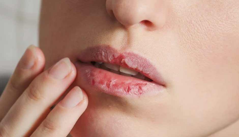 11 Home Remedies to Treat Chapped Lips