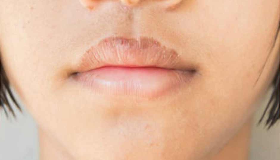 16 Home Remedies to Treat Chapped Lips Naturally