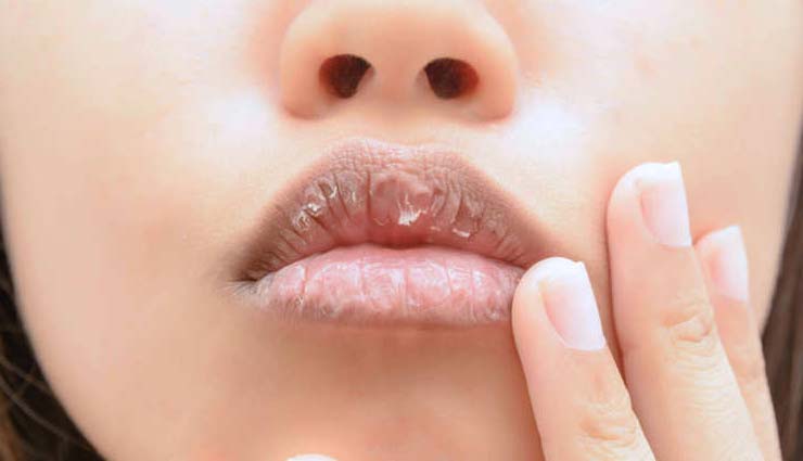 chapped lips. home remedies,home remedies to treat chapped lips,lips care tips,beauty tips,skin care tips