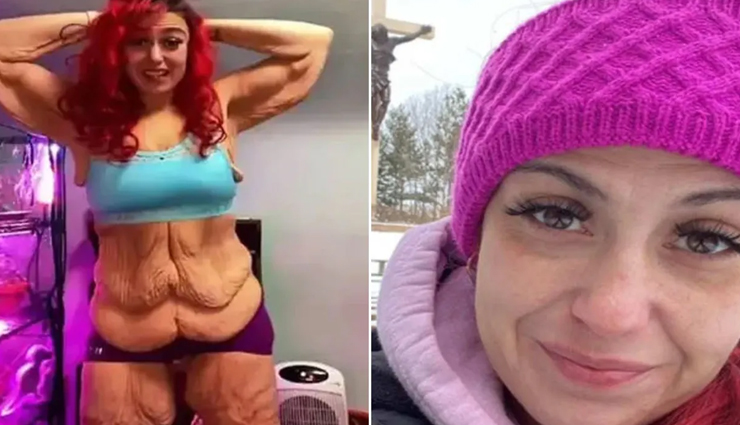 महिला ने सर्जरी से वजन तो घटाया लेकिन स्किन का हुआ बुरा हाल, जानें पूरा मामला