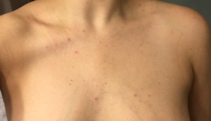 chest acne remedies,home remedies for chest acne,how to reduce chest acne naturally,natural remedies for chest acne,tips to treat chest acne at home,effective home remedies for chest acne,chest acne treatment at home,diy remedies for chest acne,best home remedies for chest acne,chest acne prevention methods