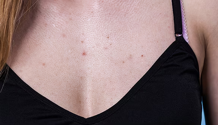 chest acne remedies,home remedies for chest acne,how to reduce chest acne naturally,natural remedies for chest acne,tips to treat chest acne at home,effective home remedies for chest acne,chest acne treatment at home,diy remedies for chest acne,best home remedies for chest acne,chest acne prevention methods