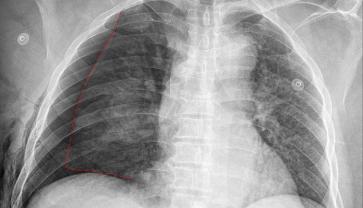 what is pneumothorax?,pneumothorax explained,understanding pneumothorax,pneumothorax causes and treatment,effective remedies for pneumothorax,pneumothorax management and treatment,remedies for pneumothorax,pneumothorax symptoms and remedies
