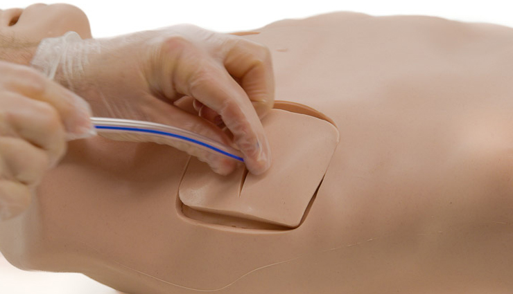 what is pneumothorax?,pneumothorax explained,understanding pneumothorax,pneumothorax causes and treatment,effective remedies for pneumothorax,pneumothorax management and treatment,remedies for pneumothorax,pneumothorax symptoms and remedies