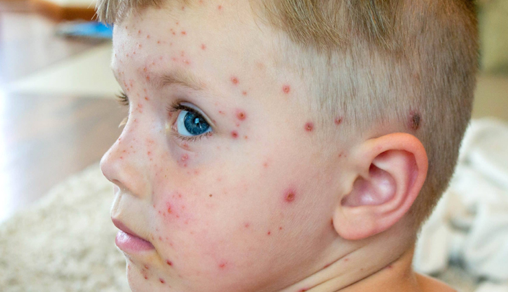 Chickenpox in Children: 10 Foods to Avoid
