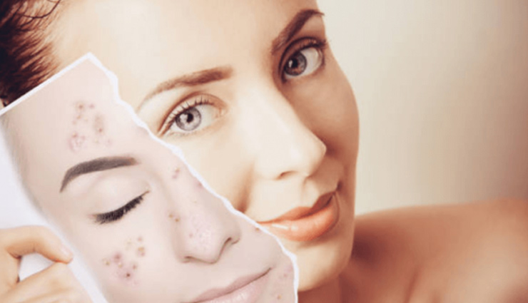 beauty,beauty tips,acne,black spots,smooth skin,glowing skin,sensitive skin,soft and glowing skin,chicken pox scars,simple beauty tips