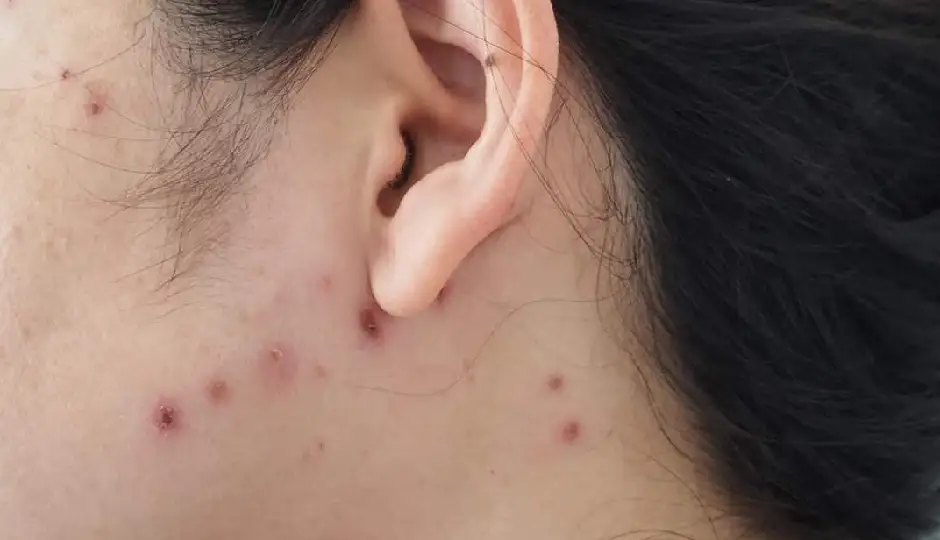चिकनपॉक्स के दाग कैसे करें हल्के? अपनाएं ये असरदार घरेलू उपाय