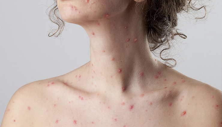 15 Remedies To Treat Chickenpox at Home