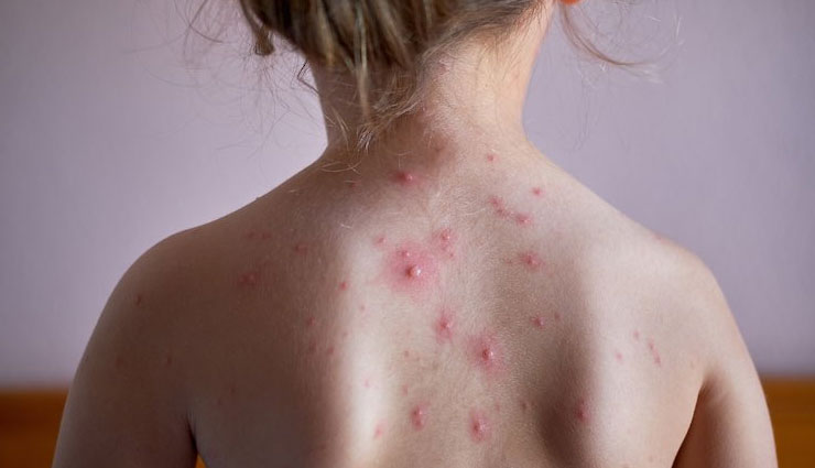 5 Home Remedies To Treat Chickenpox at Home