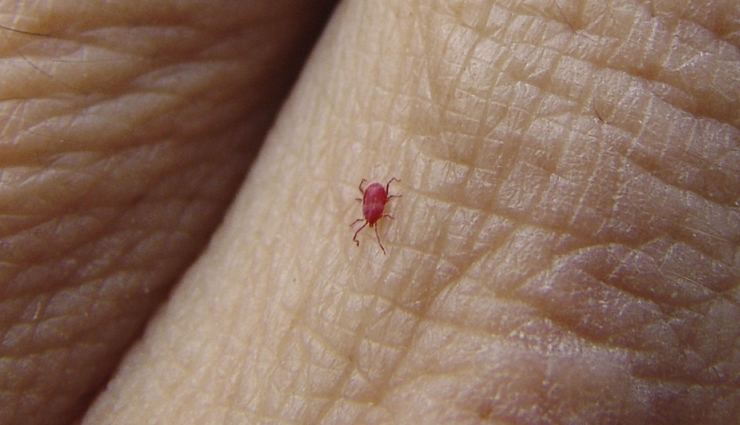 6 Remedies To Treat Chiggers Bite at Home