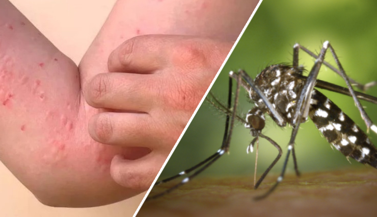 5 Foods That Will Help To Treat Chikungunya