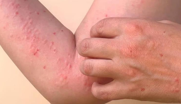 कई खतरनाक बीमारियों का कारण बनते हैं मच्छर, शुरू कर दीजिए सावधानी बरतना mosquito-borne diseases and precautions,protecting against mosquito-borne illnesses,dangers of mosquitoes and disease prevention,mosquito-borne infections and preventive measures,preventing diseases transmitted by mosquitoes,mosquito-borne illness prevention tips,importance of mosquito precautions for health,mosquito-borne diseases and proactive measures,safeguarding against mosquito-borne viruses,taking precautions against mosquito-related diseases