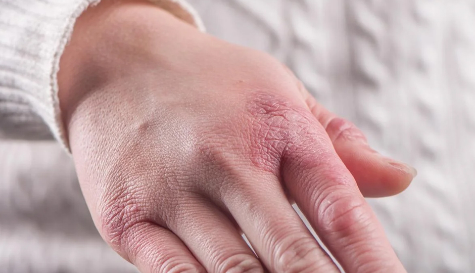 8 Effective Home Remedies To Treat Chilblains