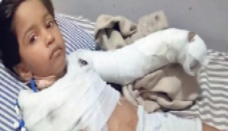 कोटा : बिजली विभाग की लापरवाही बच्ची पर पड़ी भारी, करंट से झुलसने पर काटना पड़ा एक हाथ